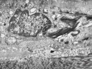 M,3y. | globoid leukodystrophy of Krabbe - n.suralis M,3y. | globoid leukodystrophy of Krabbe - n.suralis